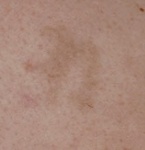 Tattoo Removal Before & After