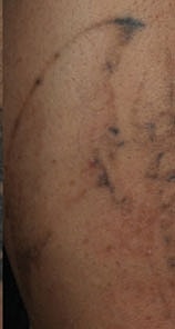 Tattoo Removal Before & After