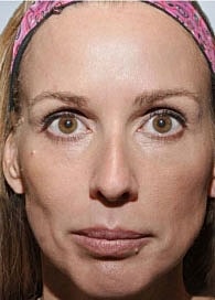 Sculptra Before & After