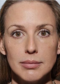 Sculptra Before & After