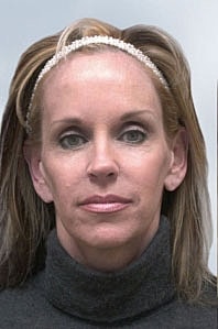 Sculptra Before & After