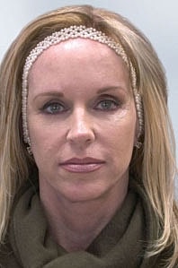 Sculptra Before & After