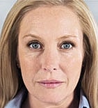 Sculptra Before & After