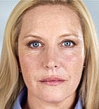 Sculptra Before & After