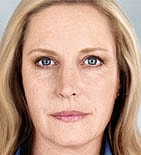Sculptra Before & After