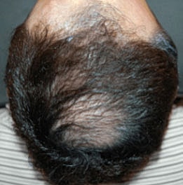 Light Therapy For Hair Growth Before & After