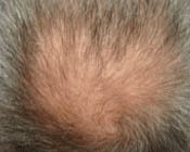 Light Therapy For Hair Growth Before & After