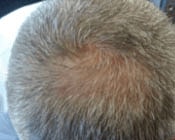 Light Therapy For Hair Growth Before & After