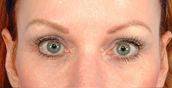 Eyebrow Transplants Before & After
