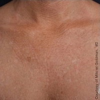 Non Surgical Skin Tightening Before & After