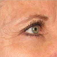 Non Surgical Skin Tightening Before & After