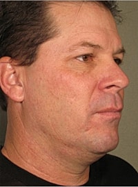 Non Surgical Skin Tightening Before & After