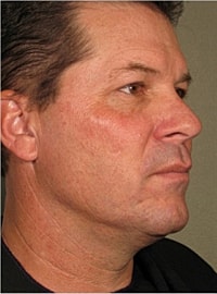 Non Surgical Skin Tightening Before & After