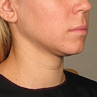 Non Surgical Skin Tightening Before & After