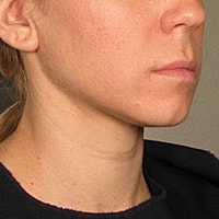 Non Surgical Skin Tightening Before & After