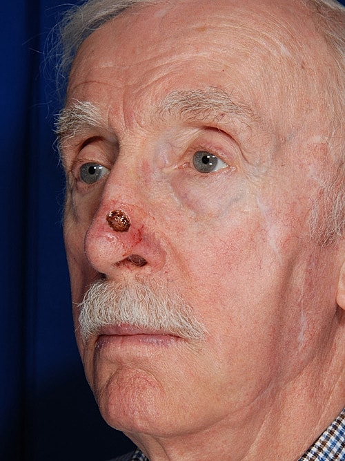 Skin Cancer Reconstruction Before & After