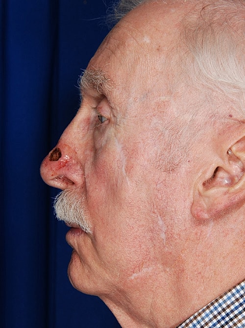 Skin Cancer Reconstruction Before & After