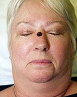 Skin Cancer Reconstruction Before & After