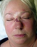Skin Cancer Reconstruction Before & After