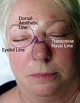 Skin Cancer Reconstruction Before & After