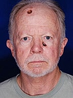 Skin Cancer Reconstruction Before & After