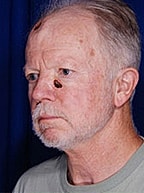 Skin Cancer Reconstruction Before & After