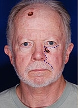 Skin Cancer Reconstruction Before & After