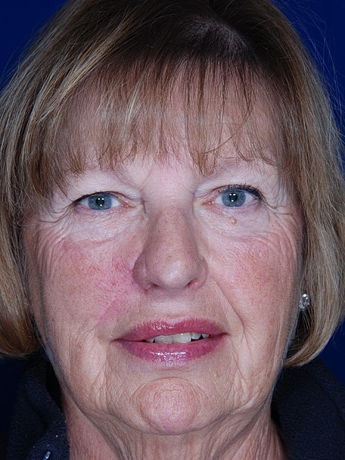 Skin Cancer Reconstruction Before & After