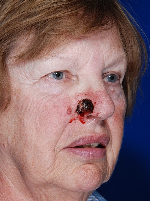 Skin Cancer Reconstruction Before & After
