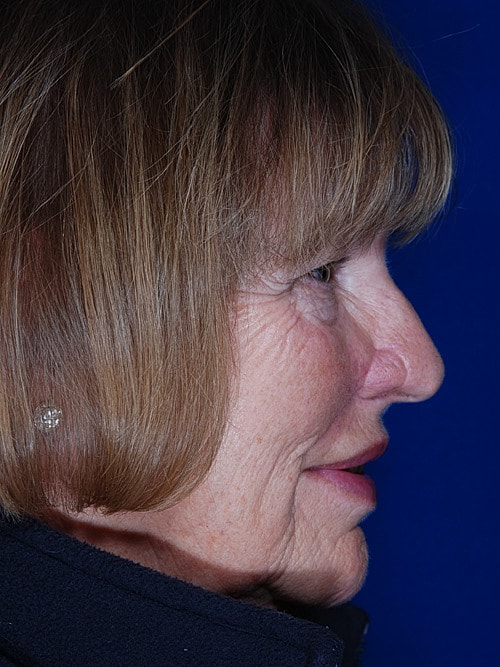 Skin Cancer Reconstruction Before & After