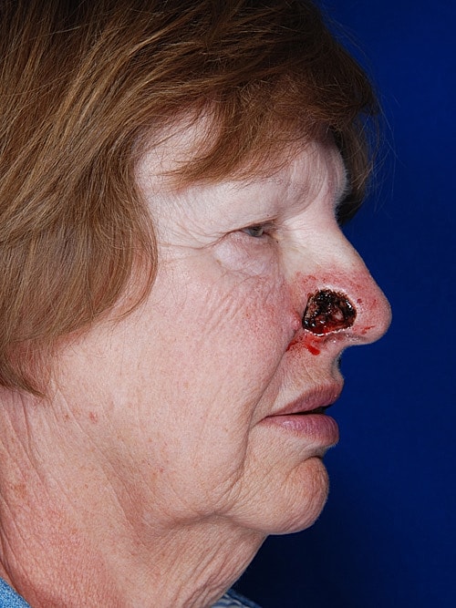 Skin Cancer Reconstruction Before & After