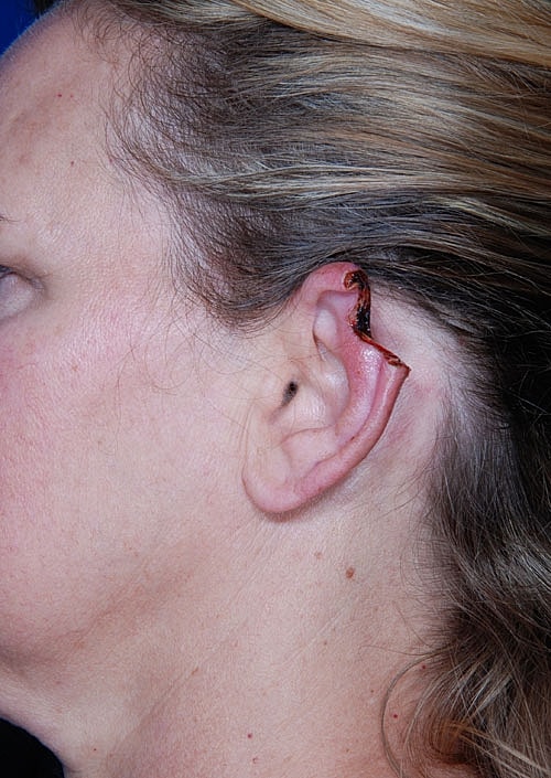 Skin Cancer Reconstruction Before & After