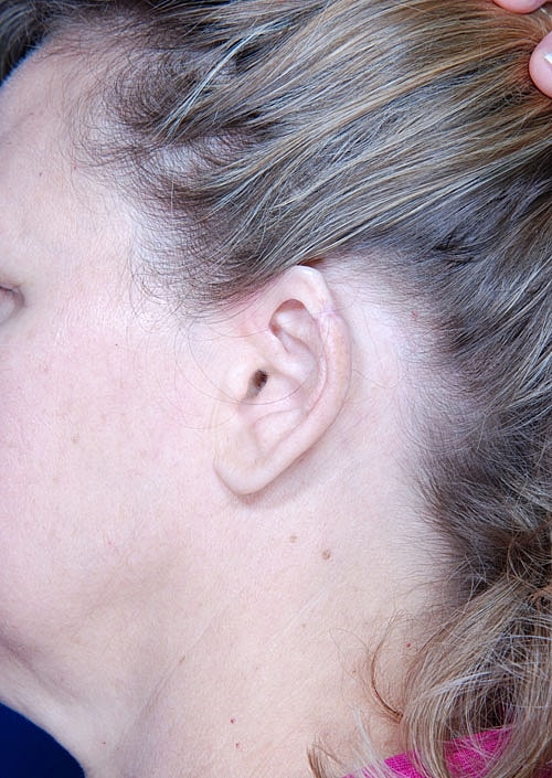 Skin Cancer Reconstruction Before & After