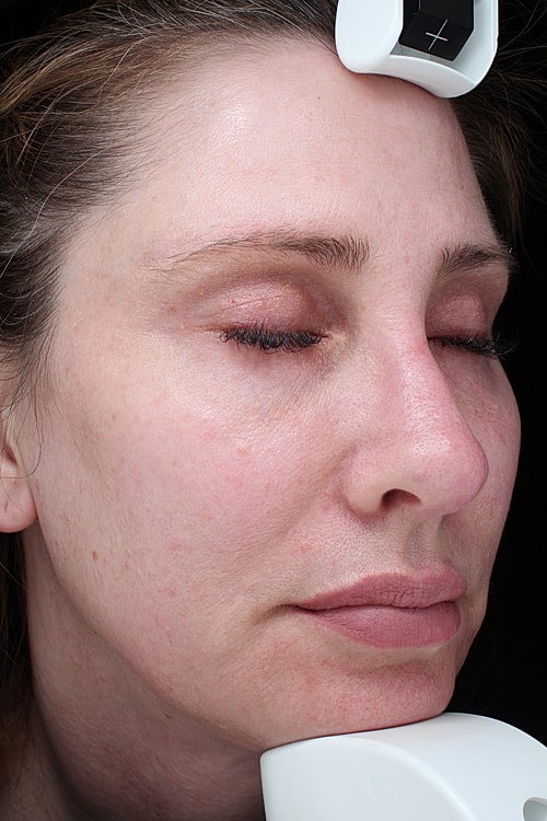 Facial Fat Transfer Before & After