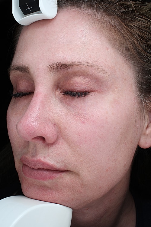 Facial Fat Transfer Before & After