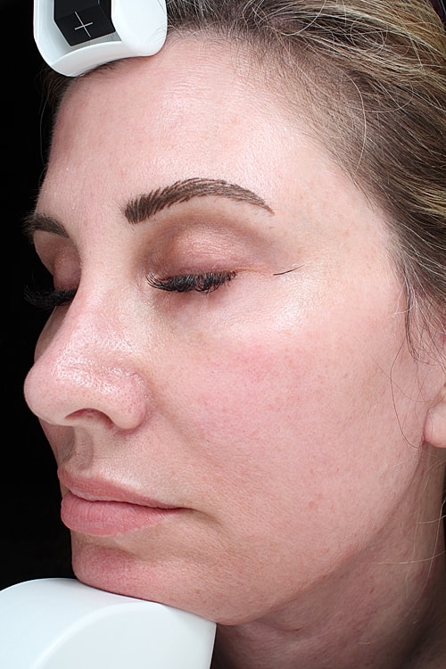 Facial Fat Transfer Before & After
