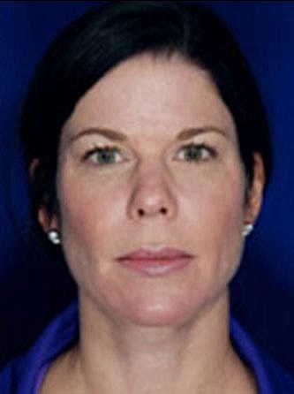 Facial Fat Transfer Before & After