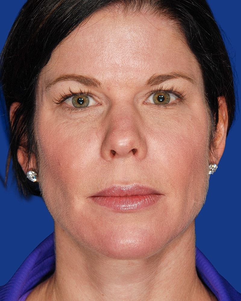 Facial Fat Transfer Before & After