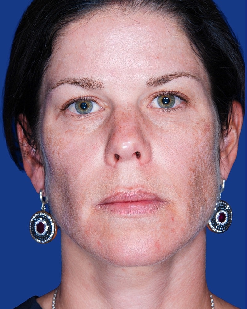 Facial Fat Transfer Before & After