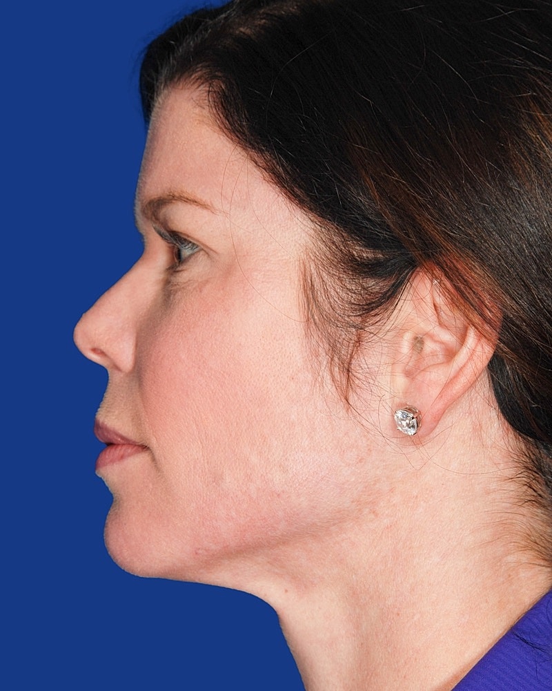 Facial Fat Transfer Before & After