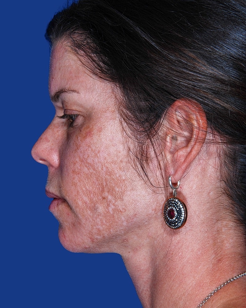 Facial Fat Transfer Before & After
