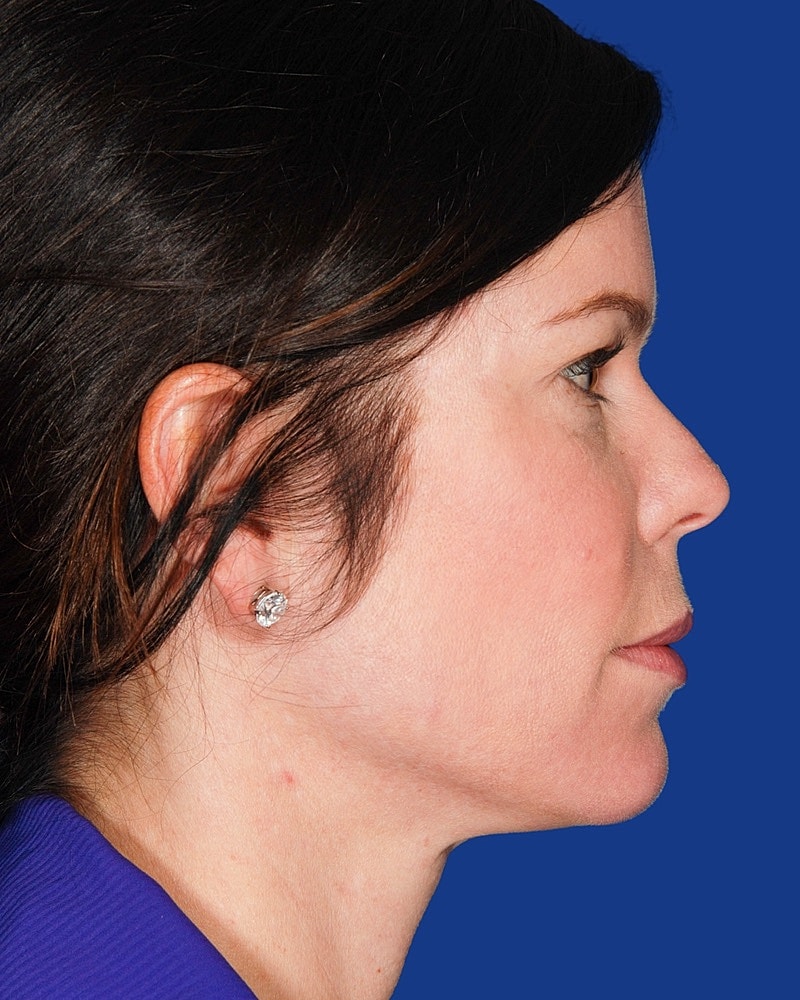 Facial Fat Transfer Before & After