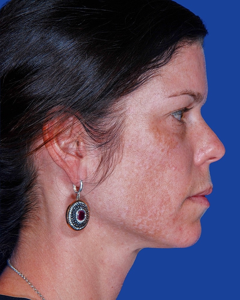 Facial Fat Transfer Before & After