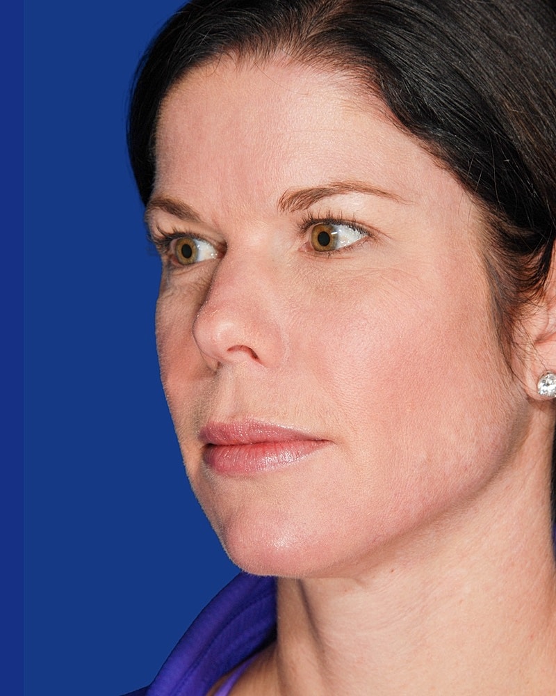 Facial Fat Transfer Before & After