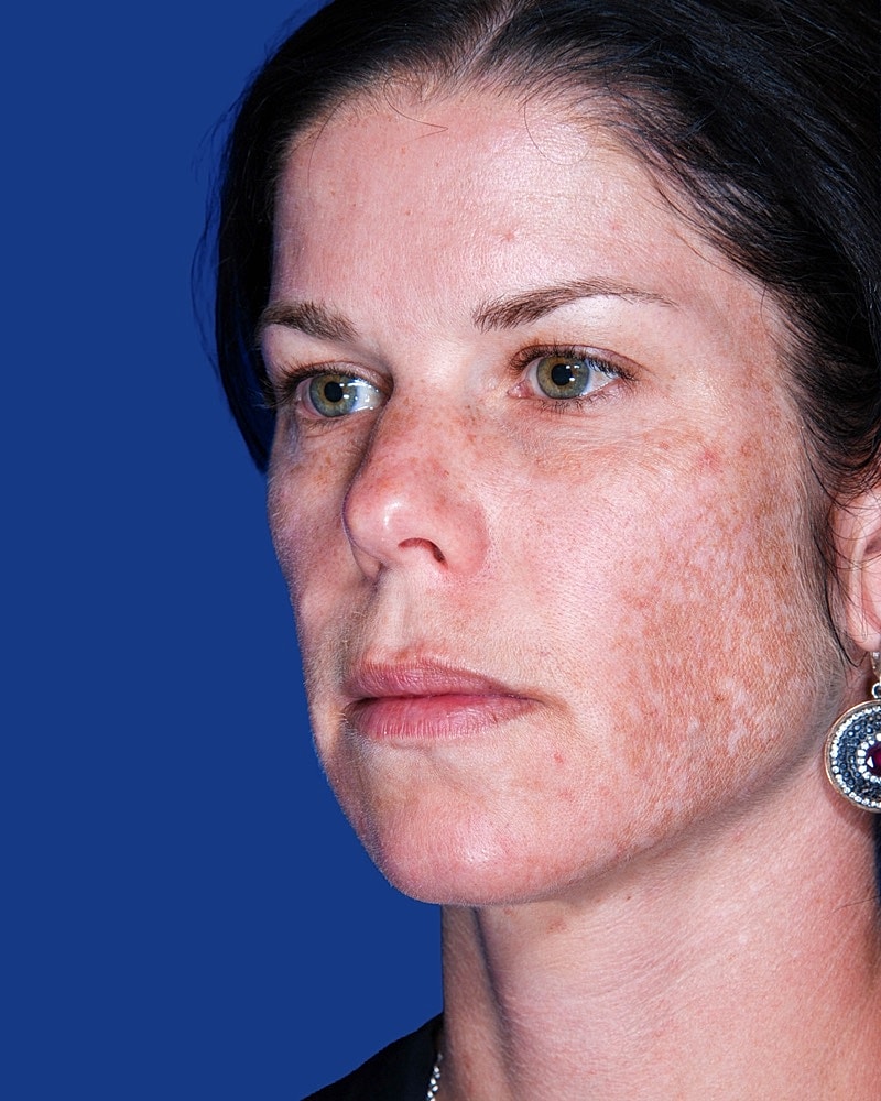 Facial Fat Transfer Before & After