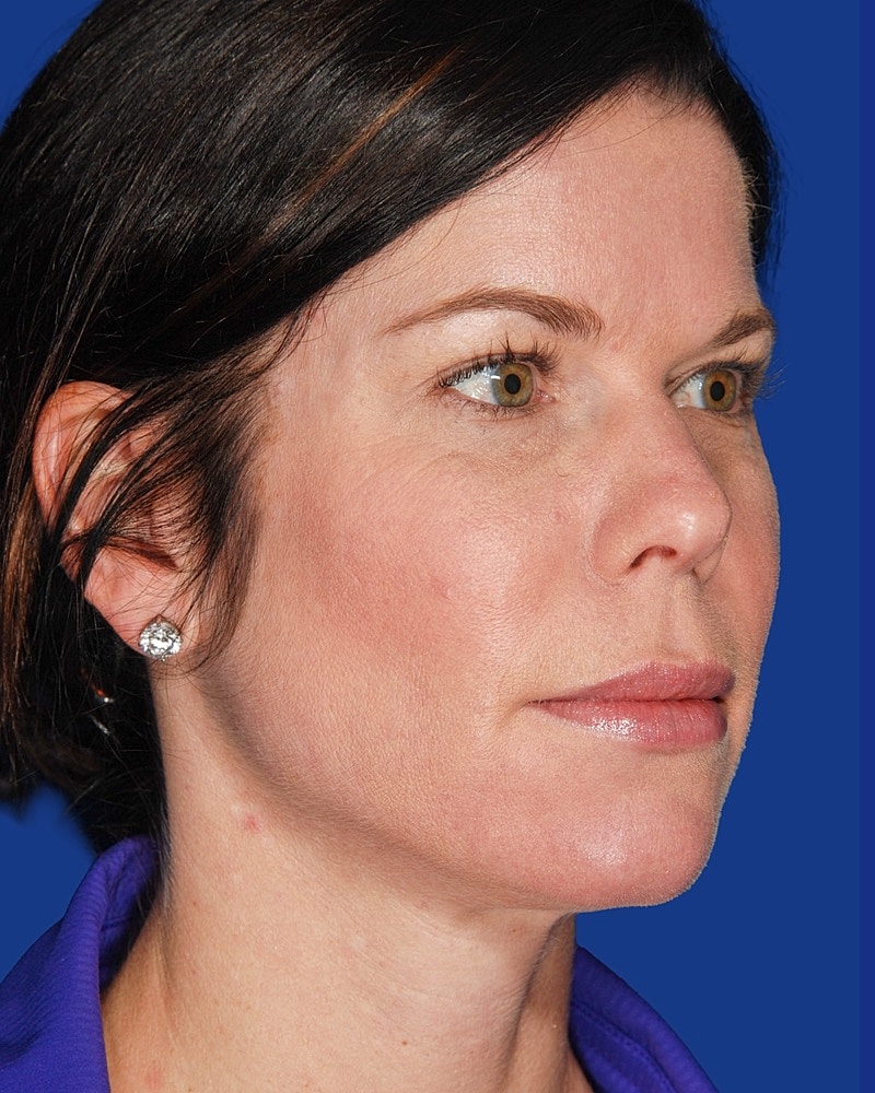 Facial Fat Transfer Before & After