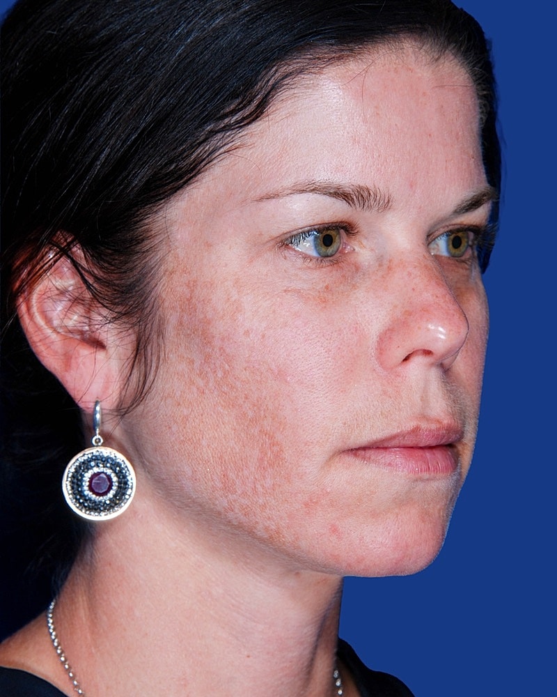 Facial Fat Transfer Before & After