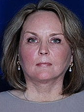 Facial Fat Transfer Before & After