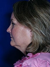 Facial Fat Transfer Before & After
