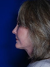 Facial Fat Transfer Before & After